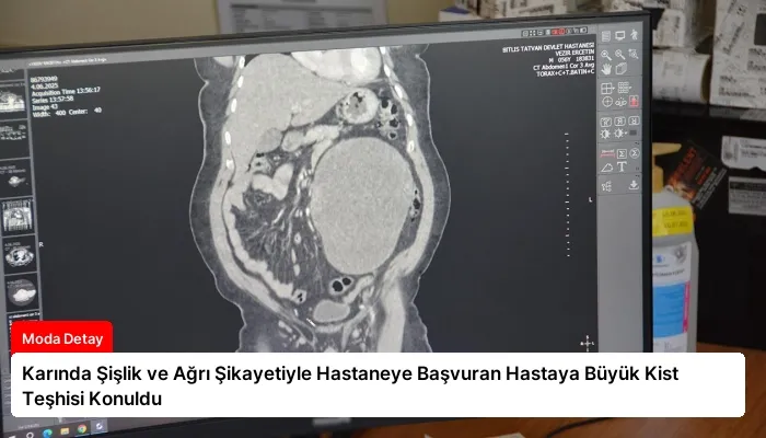 Karında Şişlik ve Ağrı Şikayetiyle Hastaneye Başvuran Hastaya Büyük Kist Teşhisi Konuldu