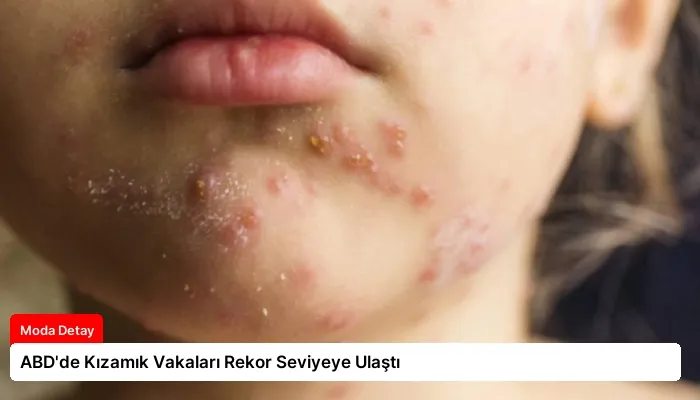 ABD’de Kızamık Vakaları Rekor Seviyeye Ulaştı