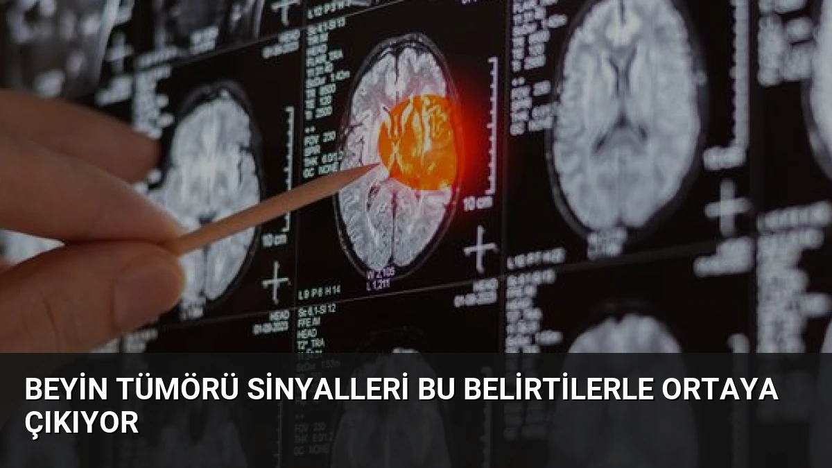 Beyin Tümörü Sinyalleri Bu Belirtilerle Ortaya Çıkıyor