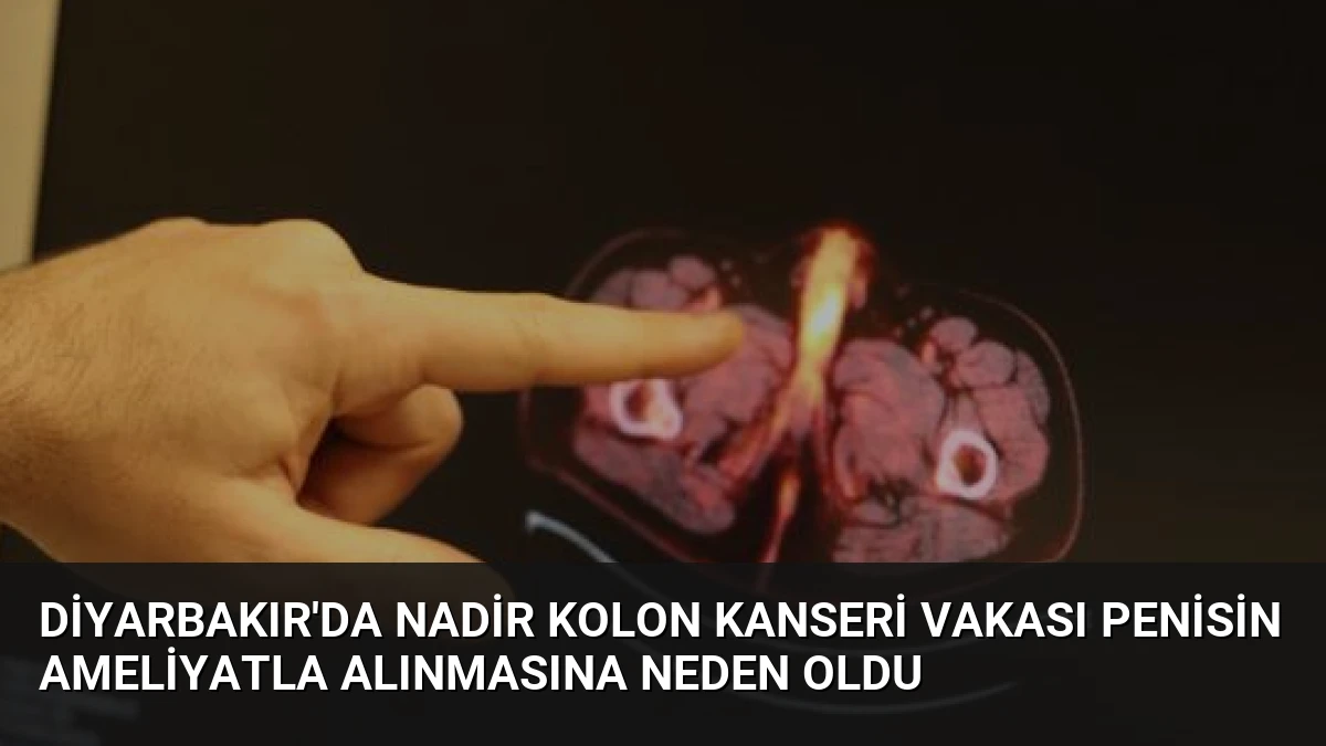 Diyarbakır’da Nadir Kolon Kanseri Vakası Penisin Ameliyatla Alınmasına Neden Oldu