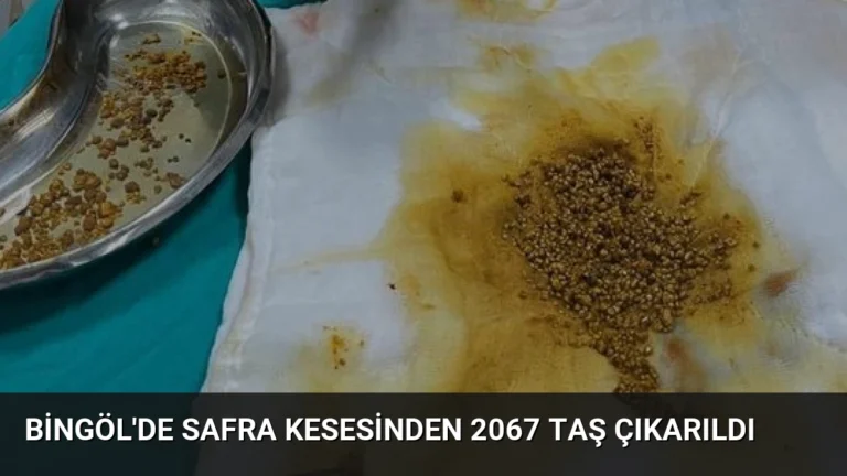 Bingöl’de Safra Kesesinden 2067 Taş Çıkarıldı