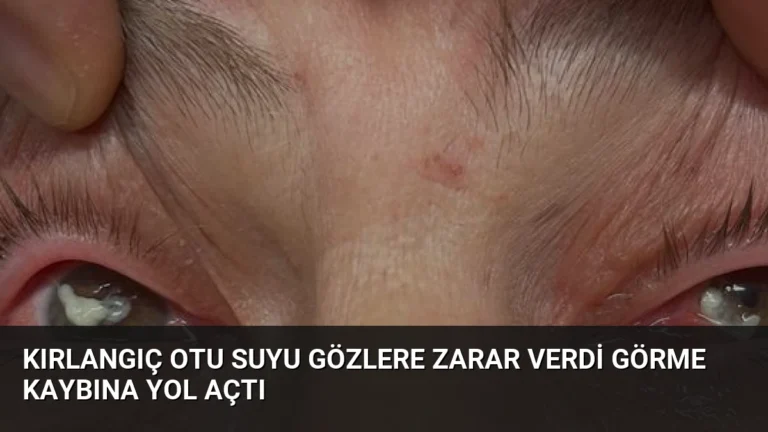 Kırlangıç Otu Suyu Gözlere Zarar Verdi Görme Kaybına Yol Açtı