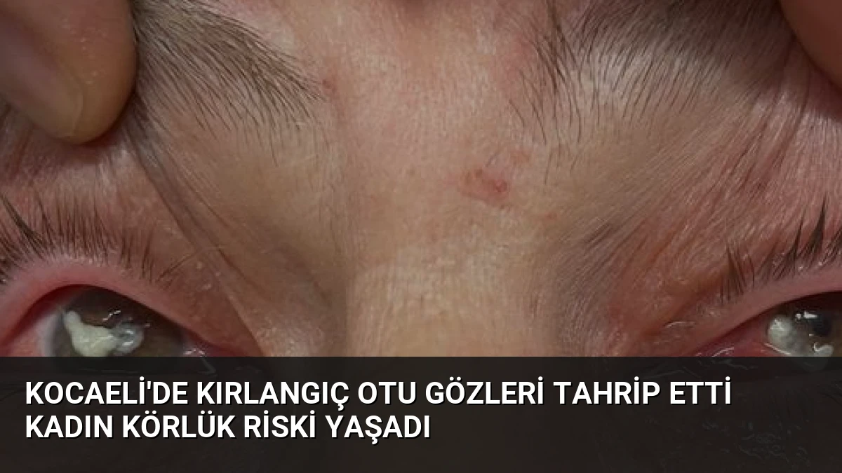 Kocaeli’de Kırlangıç Otu Gözleri Tahrip Etti Kadın Körlük Riski Yaşadı