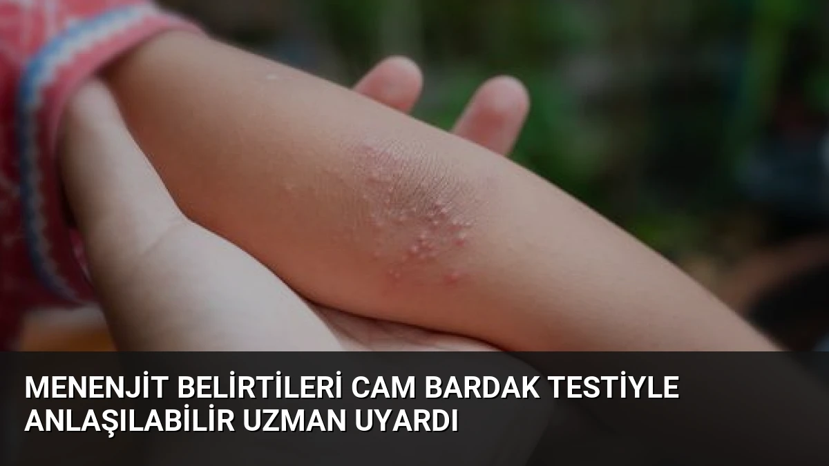 Menenjit Belirtileri Cam Bardak Testiyle Anlaşılabilir Uzman Uyardı