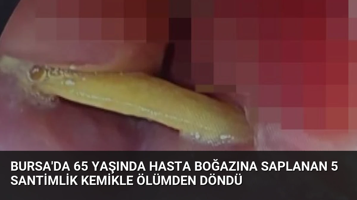 Bursa’da 65 Yaşında Hasta Boğazına Saplanan 5 Santimlik Kemikle Ölümden Döndü