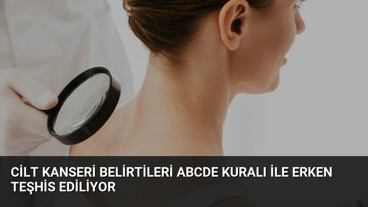 Cilt Kanseri Belirtileri ABCDE Kuralı ile Erken Teşhis Ediliyor