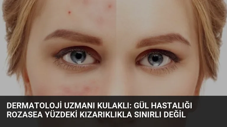 Dermatoloji Uzmanı Kulaklı: Gül Hastalığı Rozasea Yüzdeki Kızarıklıkla Sınırlı Değil
