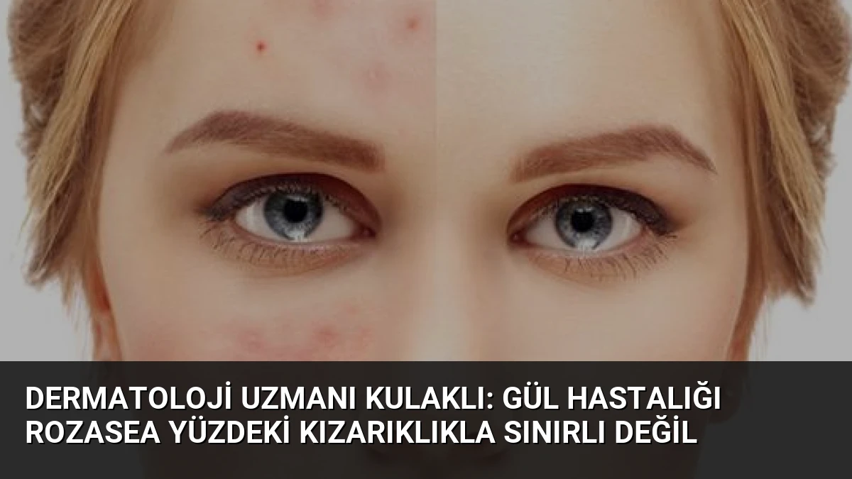 Dermatoloji Uzmanı Kulaklı: Gül Hastalığı Rozasea Yüzdeki Kızarıklıkla Sınırlı Değil