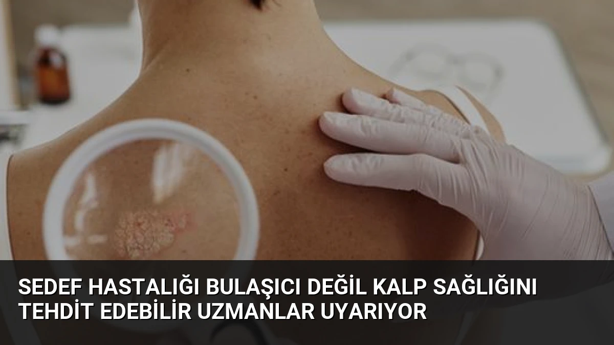 Sedef Hastalığı Bulaşıcı Değil Kalp Sağlığını Tehdit Edebilir Uzmanlar Uyarıyor